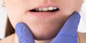 Der Arzt untersucht den Kiefer eines Mädchens, das einen Missverschluss von Mund und Zähnen hat, Nahaufnahme